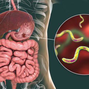Az emésztőszervrendszer 3D vizualizációja, mely nagyításban kiemelt részén a gyomorfekély egyik okozója, a helicobacter pylori látható